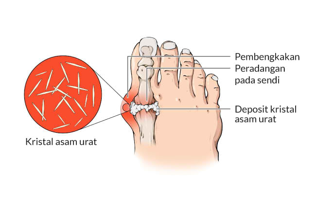 Herbal Asam urat